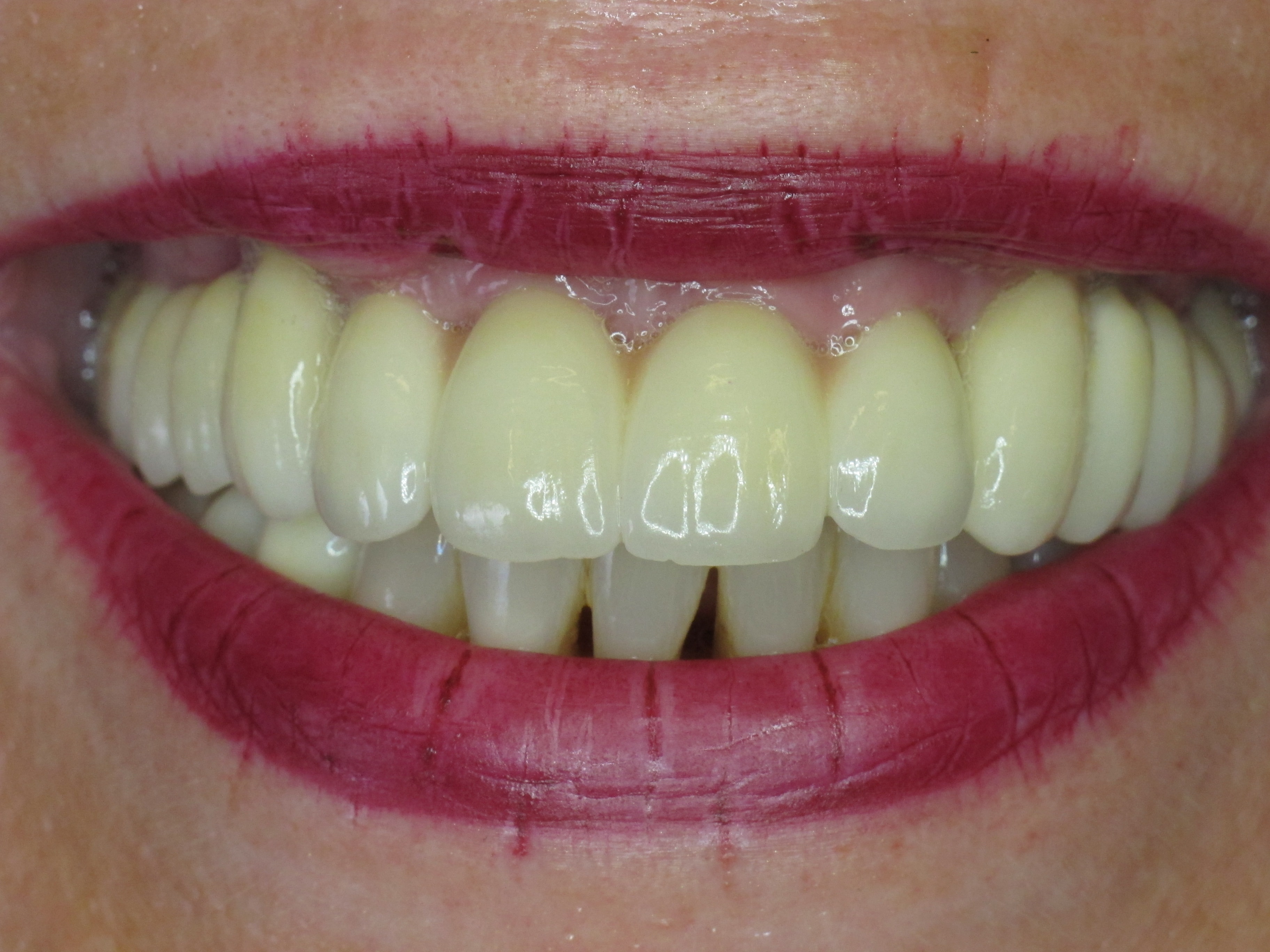 Nachher: Festsitzende Zähne auf Implantaten